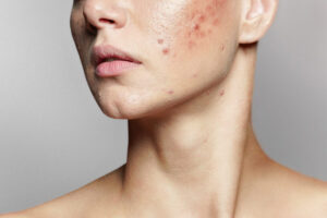 „Vírusy“, ktoré vás zbavia akné: Nová liečba je hitom medzi dermatológmi